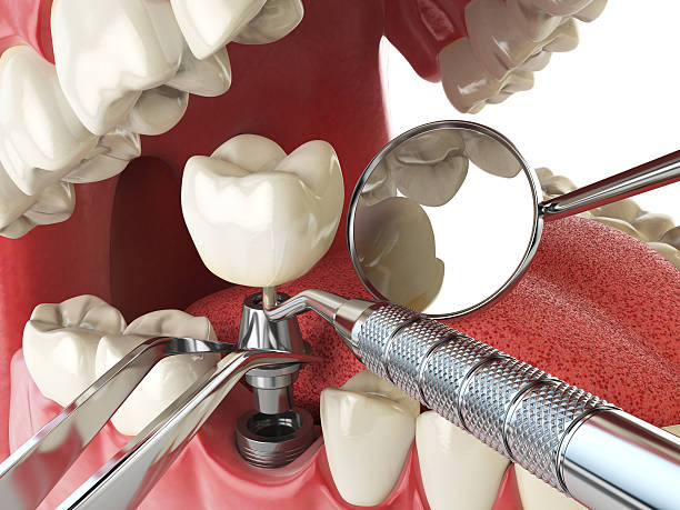 Best Emergency Dentist for Knocked-Out Tooth in Lenexa, KS
